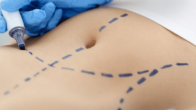 Tummy Tuck Surgeons