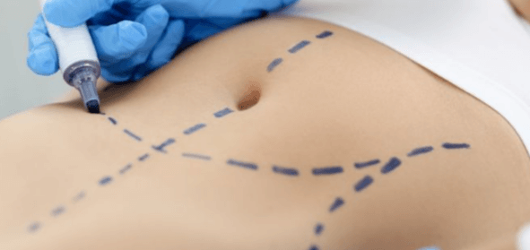 Tummy Tuck Surgeons